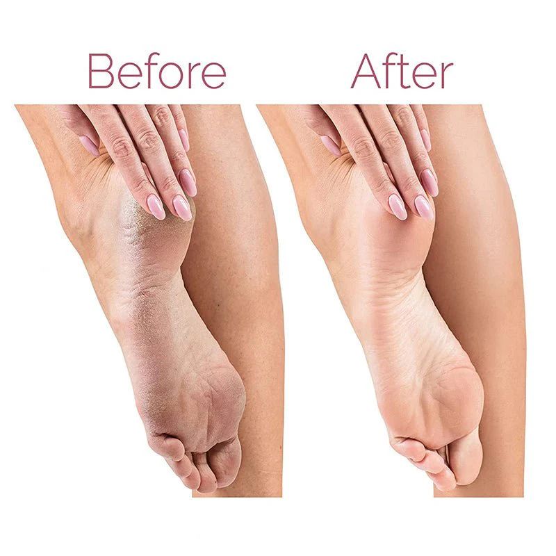 PediSilk™ Pro Electric Callus Remover
